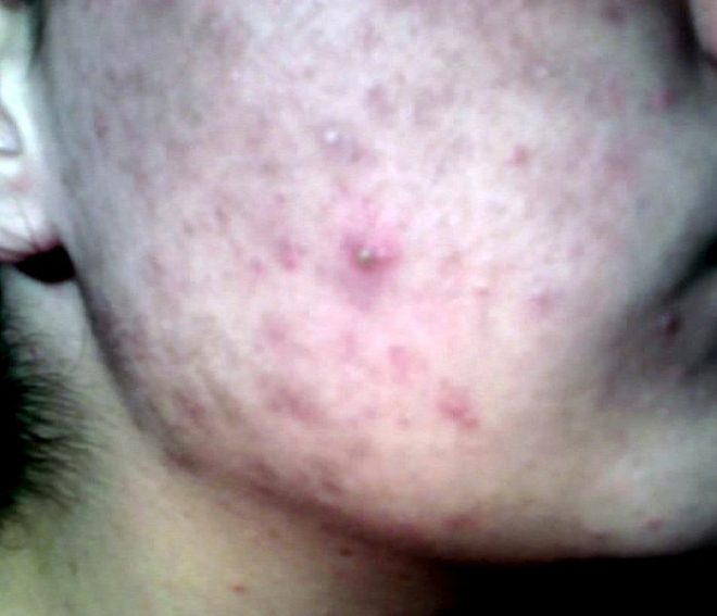 acne from dianabol